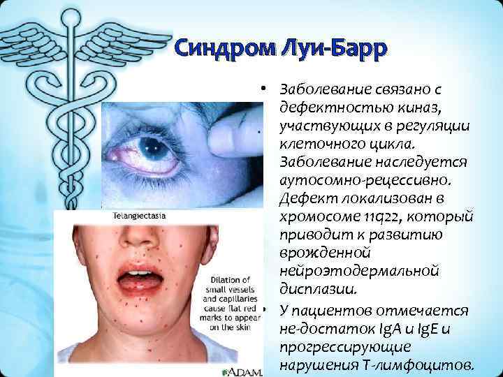 Синдром Луи-Барр • Заболевание связано с дефектностью киназ, участвующих в регуляции клеточного цикла. Заболевание