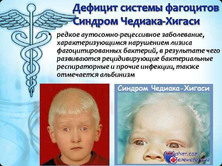 Дефицит системы фагоцитов Синдром Чедиака-Хигаси • редкое аутосомно-рецессивное заболевание, характеризующимся нарушением лизиса фагоцитированных бактерий,