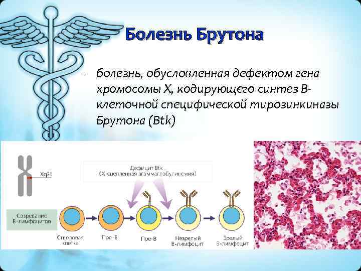Болезнь Брутона - болезнь, обусловленная дефектом гена хромосомы X, кодирующего синтез B клеточной специфической