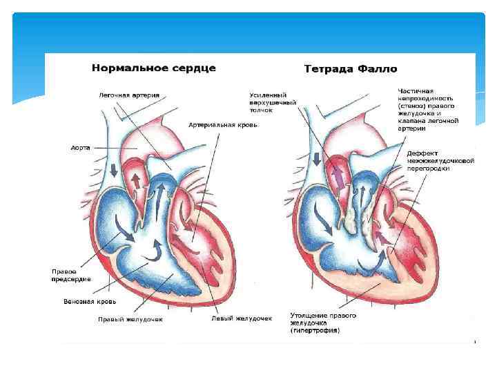 Тетрада фалло гемодинамика схема