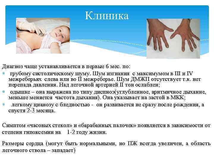 Клиника Диагноз чаще устанавливается в первые 6 мес. по: грубому систолическому шуму. Шум изгнания