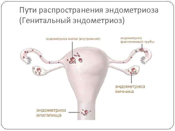 Пути распространения эндометриоза (Генитальный эндометриоз) 
