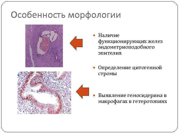 Особенность морфологии Наличие функционирующих желез эндометриоподобного эпителия Определение цитогенной стромы Выявление гемосидерина в макрофагах