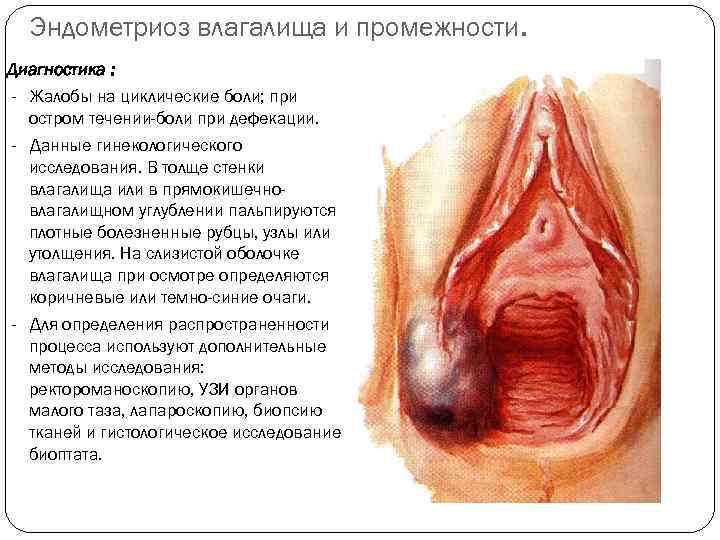 Эндометриоз влагалища и промежности. Диагностика : - Жалобы на циклические боли; при остром течении-боли