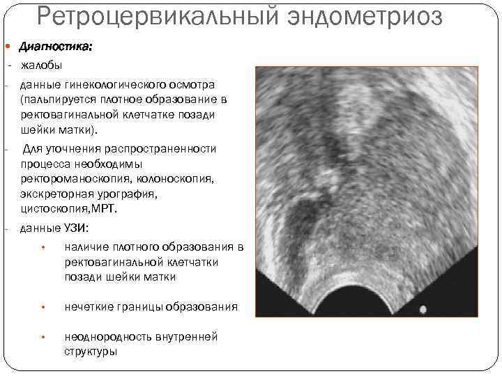 Клиническая картина эндометриоза