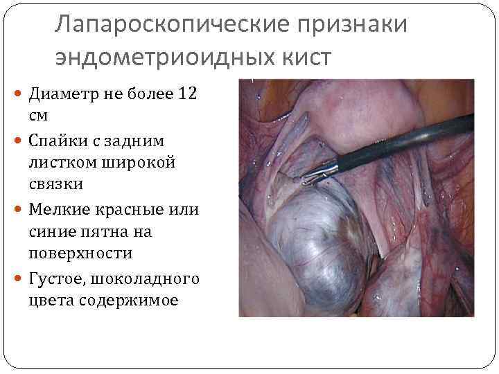Лапароскопические признаки эндометриоидных кист Диаметр не более 12 см Спайки с задним листком широкой