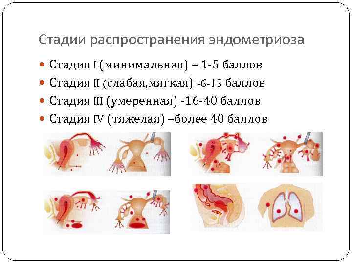 Стадии распространения эндометриоза Стадия I (минимальная) – 1 -5 баллов Стадия II (слабая, мягкая)