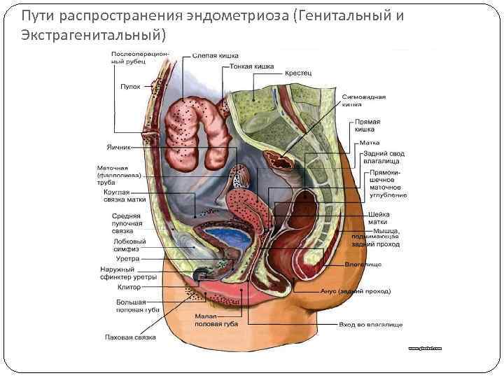 Пути распространения эндометриоза (Генитальный и Экстрагенитальный) 