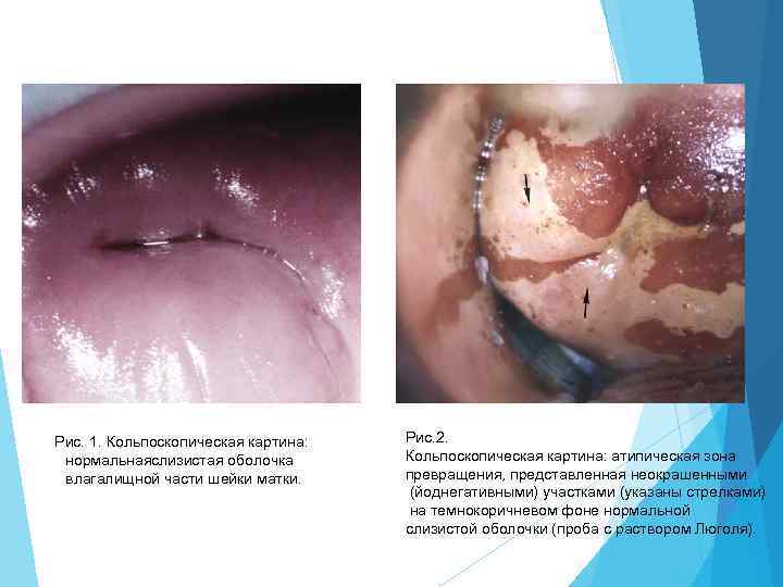 Рис. 1. Кольпоскопическая картина: нормальнаяслизистая оболочка влагалищной части шейки матки. Рис. 2. Кольпоскопическая картина: