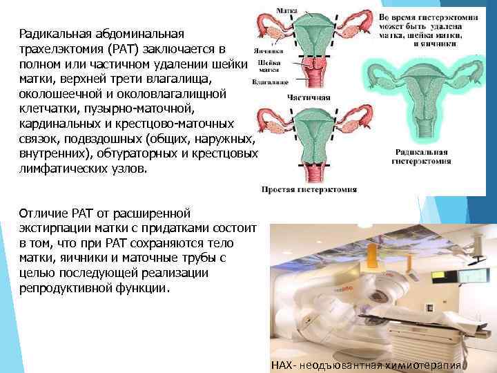 Радикальная абдоминальная трахелэктомия (РАТ) заключается в полном или частичном удалении шейки матки, верхней трети