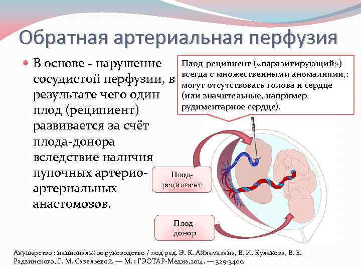 Обратная артериальная перфузия В основе - нарушение Плод-реципиент ( «паразитирующий» ) сосудистой перфузии, в