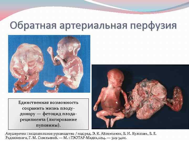 Обратная артериальная перфузия Единственная возможность сохранить жизнь плодудонору — фетоцид плодареципиента (лигирование пуповины). Акушерство