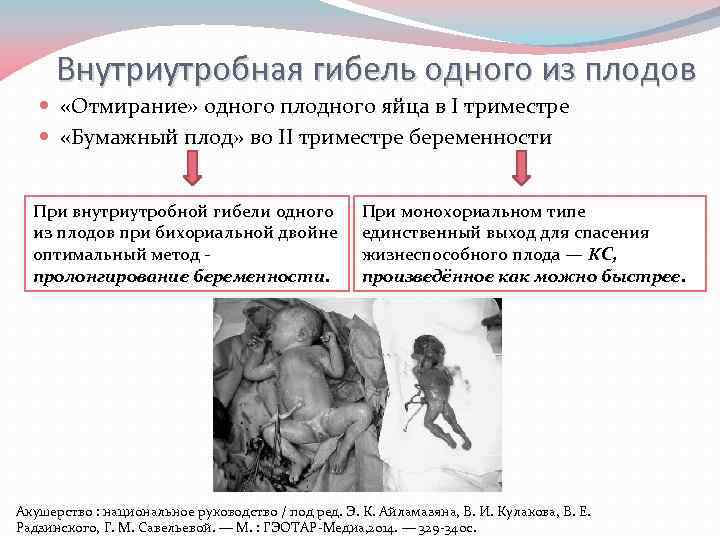 Внутриутробная гибель одного из плодов «Отмирание» одного плодного яйца в I триместре «Бумажный плод»