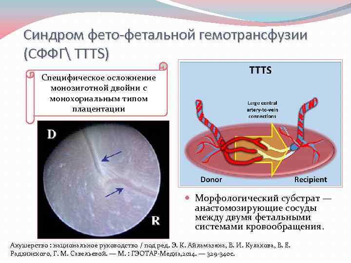 Синдром фето-фетальной гемотрансфузии (СФФГ TTTS) Специфическое осложнение монозиготной двойни с монохориальным типом плацентации Морфологический