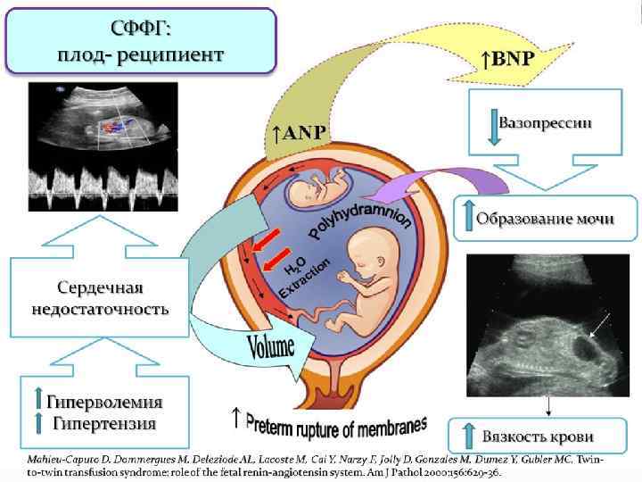 СФФГ: плод- реципиент Вазопрессин Образование мочи Сердечная недостаточность Гиперволемия Гипертензия Вязкость крови Mahieu-Caputo D,