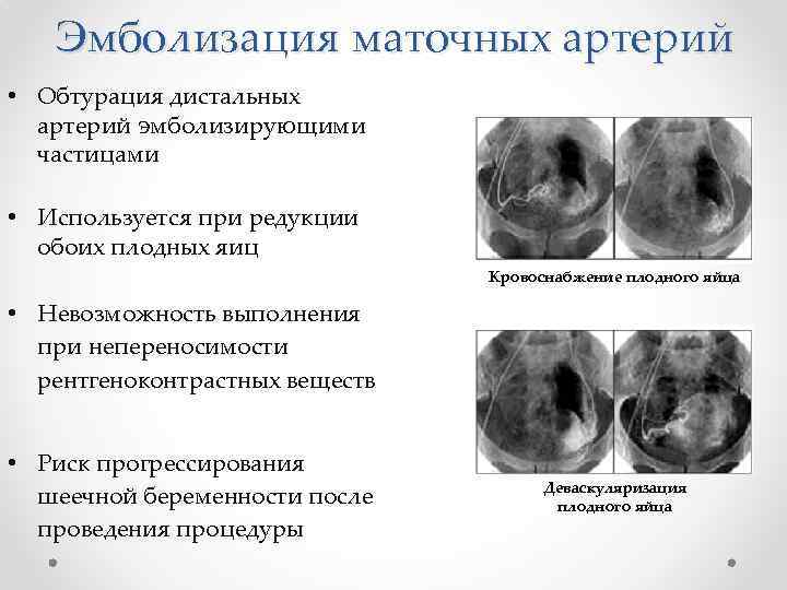 Эмболизация маточных артерий • Обтурация дистальных артерий эмболизирующими частицами • Используется при редукции обоих