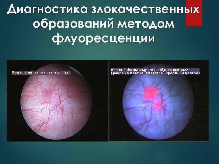 Диагностика злокачественных образований методом флуоресценции 