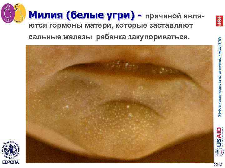 Милия (белые угри) - причиной являсальные железы ребенка закупориваться. Эффективная перинатальная помощь и уход