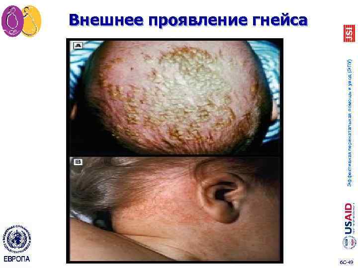 Эффективная перинатальная помощь и уход (ЭПУ) Внешнее проявление гнейса 6 C 49 