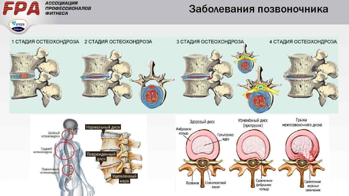 Заболевание позвоночника остеохондроз. Этапы формирования грыжи межпозвоночного диска. Остеохондроз двигательных сегментов позвоночника. Механизм развития остеохондроза. Стадии развития болезней позвоночника.