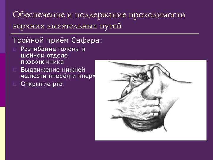 Обеспечение и поддержание проходимости верхних дыхательных путей Тройной приём Сафара: p p p Разгибание