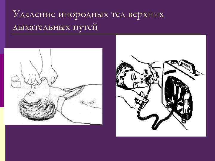 Удаление инородных тел верхних дыхательных путей 