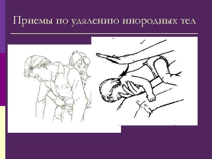 Приемы по удалению инородных тел 