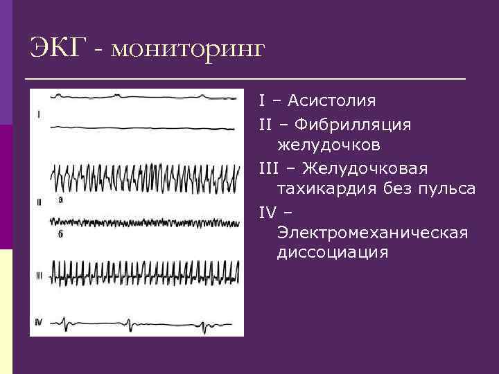 ЭКГ - мониторинг I – Асистолия II – Фибрилляция желудочков III – Желудочковая тахикардия