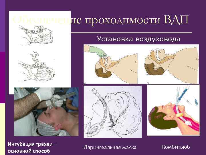 Обеспечение проходимости ВДП Установка воздуховода Интубация трахеи – основной способ Ларингеальная маска Комбитьюб 