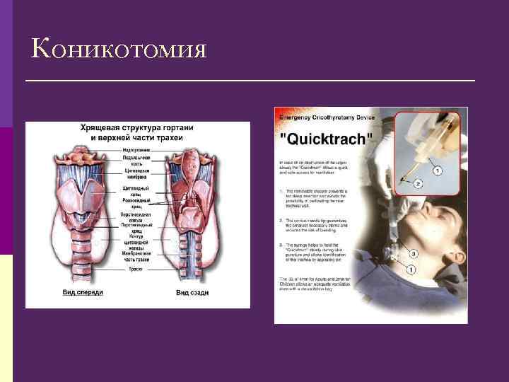 Коникотомия 
