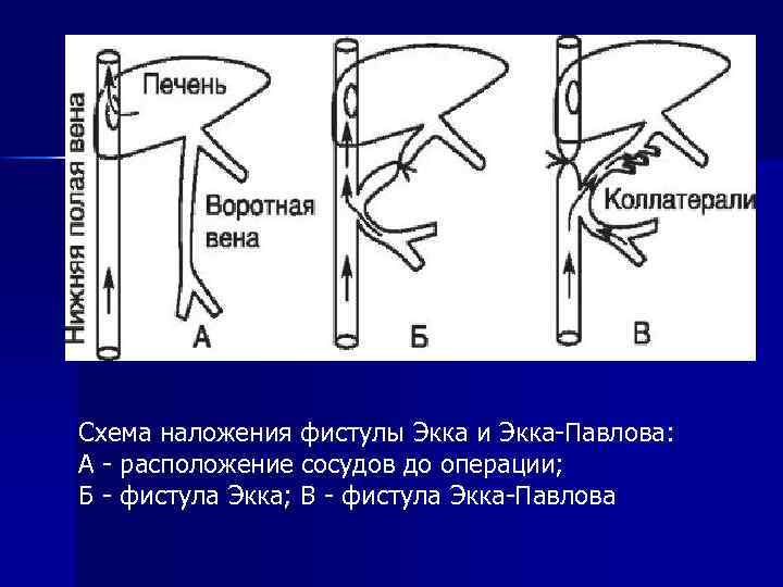 Схема наложения фистулы Экка и Экка-Павлова: А - расположение сосудов до операции; Б -