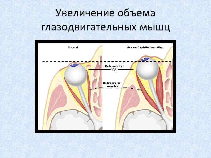 Схемы пульс терапии при эндокринной офтальмопатии