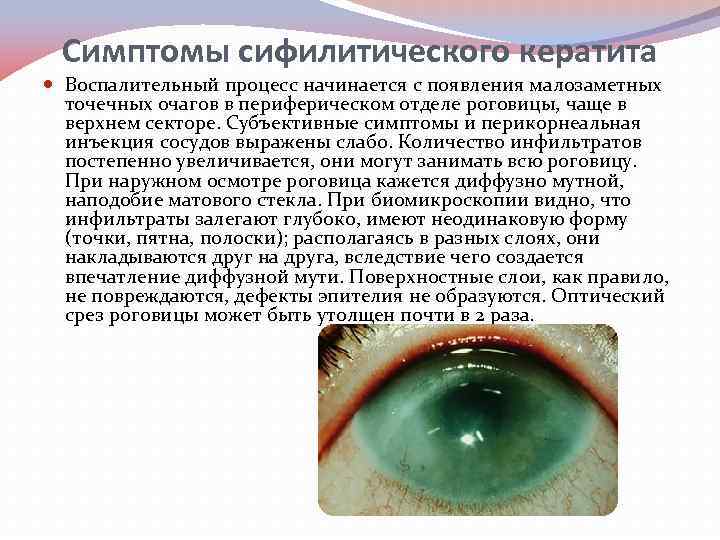 Симптомы сифилитического кератита Воспалительный процесс начинается с появления малозаметных точечных очагов в периферическом отделе
