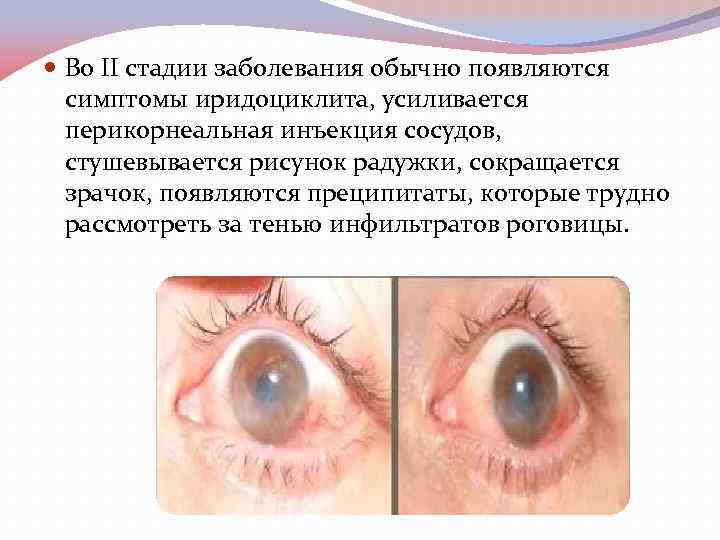  Во II стадии заболевания обычно появляются симптомы иридоциклита, усиливается перикорнеальная инъекция сосудов, стушевывается
