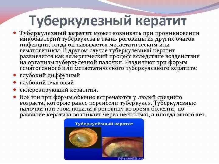 Туберкулезный кератит может возникать при проникновении микобактерий туберкулеза в ткань роговицы из других очагов