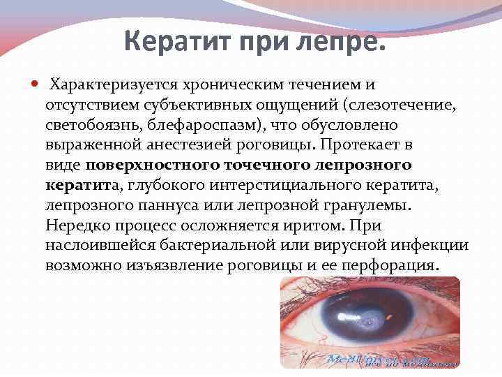 Кератит при лепре. Характеризуется хроническим течением и отсутствием субъективных ощущений (слезотечение, светобоязнь, блефароспазм), что
