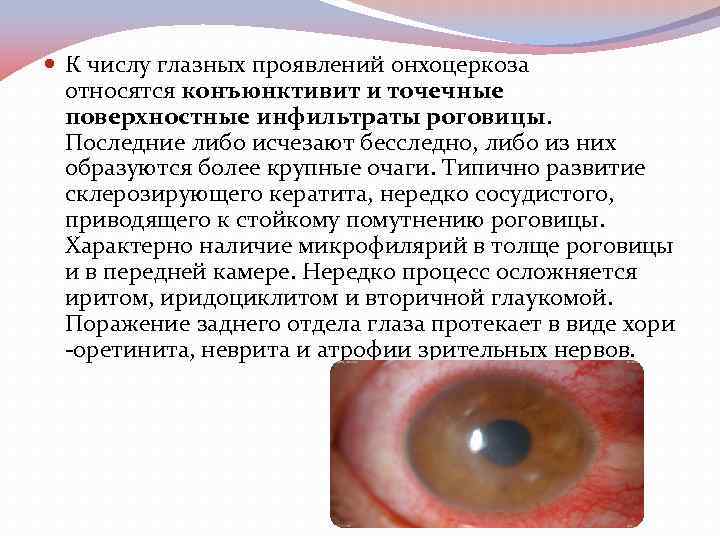  К числу глазных проявлений онхоцеркоза относятся конъюнктивит и точечные поверхностные инфильтраты роговицы. Последние