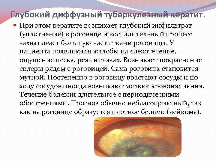 Глубокий диффузный туберкулезный кератит. При этом кератите возникает глубокий инфильтрат (уплотнение) в роговице и