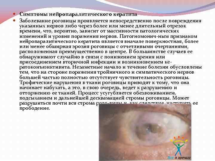 Симптомы нейропаралитического кератита Заболевание роговицы проявляется непосредственно после повреждения указанных нервов либо через