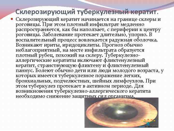 Склерозирующий туберкулезный кератит. Склерозирующий кератит начинается на границе склеры и роговицы. При этом плотный
