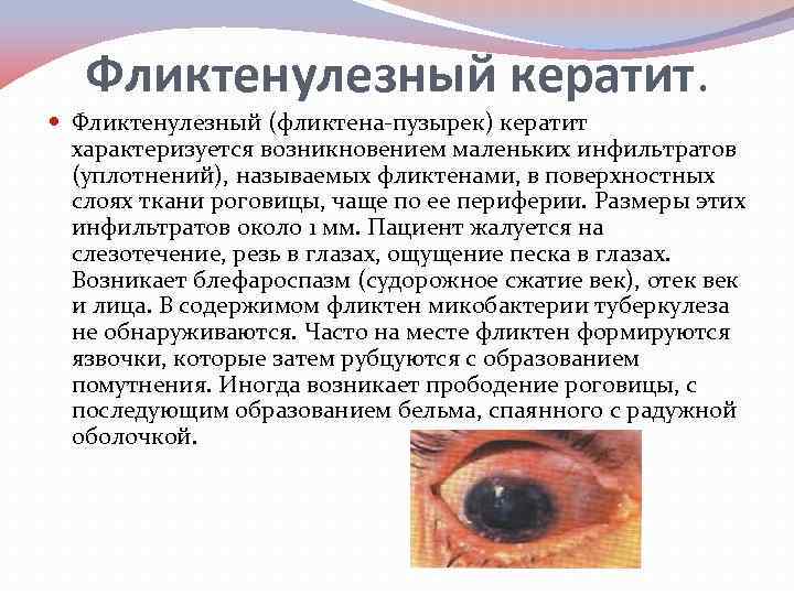 Фликтенулезный кератит. Фликтенулезный (фликтена пузырек) кератит характеризуется возникновением маленьких инфильтратов (уплотнений), называемых фликтенами, в