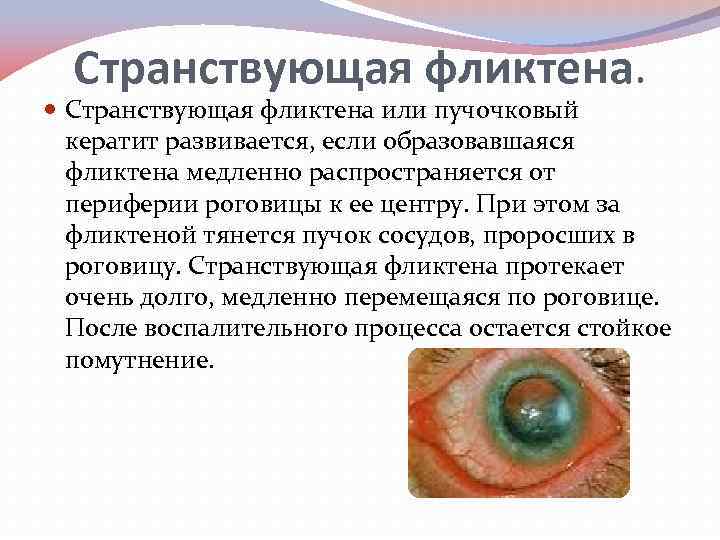 Странствующая фликтена или пучочковый кератит развивается, если образовавшаяся фликтена медленно распространяется от периферии роговицы