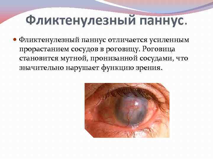 Фликтенулезный паннус. Фликтенулезный паннус отличается усиленным прорастанием сосудов в роговицу. Роговица становится мутной, пронизанной