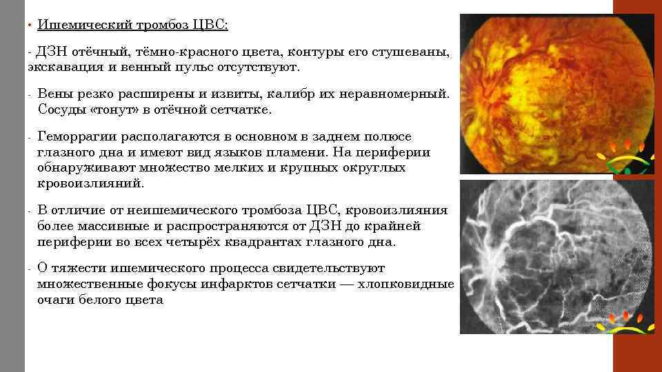  • Ишемический тромбоз ЦВС: - ДЗН отёчный, тёмно-красного цвета, контуры его стушеваны, экскавация