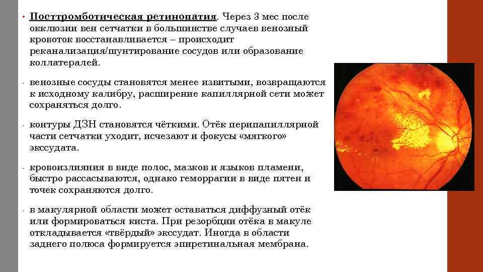  • Посттромботическая ретинопатия. Через 3 мес после окклюзии вен сетчатки в большинстве случаев