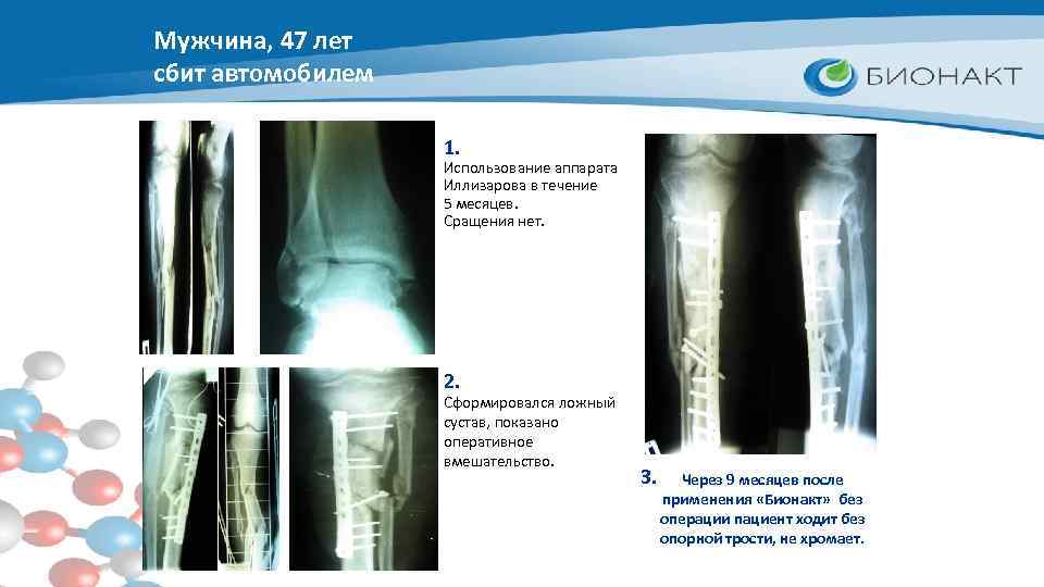 Мужчина, 47 лет сбит автомобилем 1. Использование аппарата Иллизарова в течение 5 месяцев. Сращения