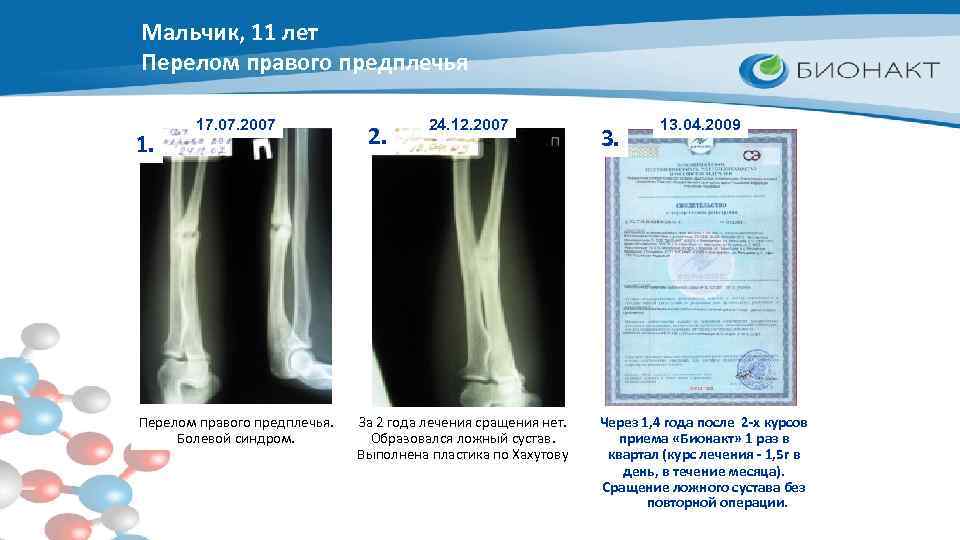Мальчик, 11 лет Перелом правого предплечья 1. 17. 07. 2007 Перелом правого предплечья. Болевой