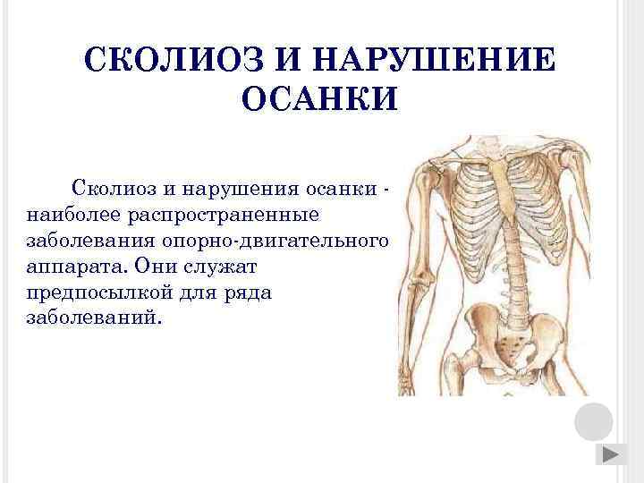 СКОЛИОЗ И НАРУШЕНИЕ ОСАНКИ Сколиоз и нарушения осанки наиболее распространенные заболевания опорно-двигательного аппарата. Они