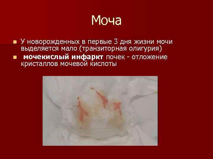 Моча У новорожденных в первые 3 дня жизни мочи выделяется мало (транзиторная олигурия) n