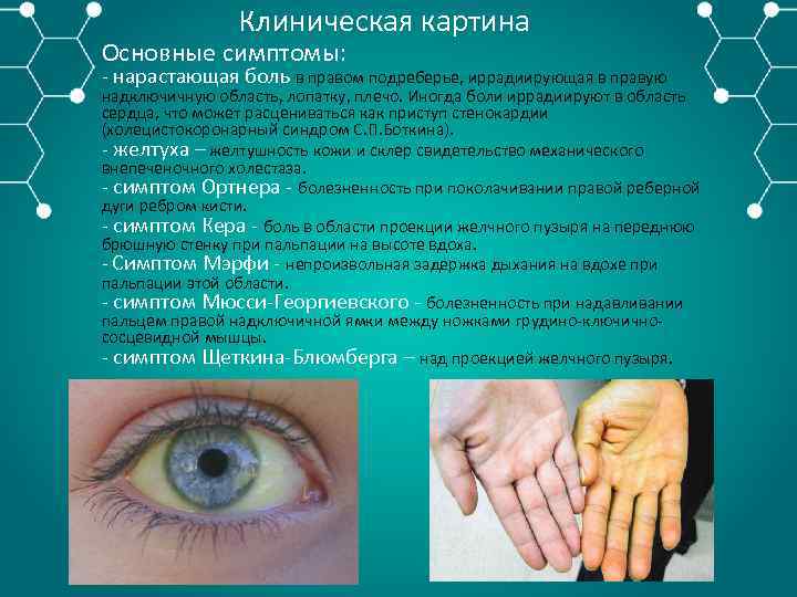 Клиническая картина Основные симптомы: нарастающая боль в правом подреберье, иррадиирующая в правую надключичную область,